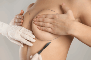 Breast Augmentation