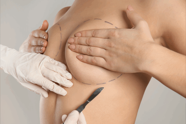 Breast Augmentation